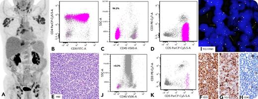 A 75-year-old man was referred to us with an outside diagnosis of T-cell prolymphocytic leukemia (T-PLL) posttreatment. He had mild leukocytosis (white blood cell count, 11.5 × 109/L) and multicompartmental lymphadenopathy by positron emission tomography–computed tomography (panel A) (maximum standardized uptake value, 6.3). A bone marrow (BM) biopsy showed no lymphoid infiltrate, and results of concurrent flow cytometry immunophenotyping (FCI) were negative. An axillary lymph node (LN) biopsy was subsequently performed. FCI failed to reveal aberrant T cells within lymphocyte gate but showed a large CD45− population (CD2+CD5+CD4+CD8+CD7bright+CD26bright+CD52+) negative for surface CD3 (sCD3) and CD45 (panels B-D; FITC, fluorescein isothiocyanate; PE, phycoerythrin; SSC, side scatter). Hematoxylin and eosin (panel E; original magnification ×40) and immunohistochemical stains of LN biopsy showed architectural effacement by small to medium-sized neoplastic T cells that were cytoplasmic CD3+CD4+CD8+TCL-1+ (panels F-G, original magnification ×40) and negative for CD34/CD45/CD1a/terminal deoxynucleotidyltransferase (panel H, original magnification ×40). Fluorescence in situ hybridization (FISH) using a TCL-1 break-apart probe was positive for TCL-1 rearrangement (panel I). BM FCI was retrospectively reanalyzed to include CD45−sCD3− cells and revealed minimal involvement by T-PLL (0.3%) (panels J-K). / T-PLL is a rare, aggressive, mostly CD45+sCD3+ postthymic T-cell leukemia. In 5% to 10% of cases, either of these markers may be negative; however, simultaneous loss of both is extremely rare. This is problematic, since most of the FCI assays for T-cell lymphoma/leukemia focus on lymphocytes as defined by CD45/side scatter, with additional analysis on CD3+ cells. This is challenging when the initial immunophenotype is unknown and involvement is minimal. Understanding this immunophenotype and using alternative gating strategy are essential to avoid false-negative results.
