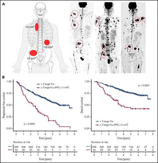 Figure 1. The impact of focal lesion size on outcome. (A) The FL-HiR pattern as seen in whole-body diffusion-weighted MRI scan with background suppression. It consists of ≥3 large FLs, each with a PPD ≥5 cm2. (B) Outcome of 404 NDMM patients enrolled into Total Therapy trials stratified by this pattern. Log-rank test was used to perform the group comparison.