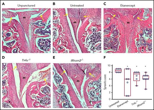 Figure 3. Histopathological analysis of the knee joints 2 weeks after needle injury. Unpunctured control joints of F8−/− mice (A) and severe thickening of the synovium with inflammation in the punctured, but untreated, joints of F8−/− animals (B). Representative hematoxylin and eosin–stained sections of joints from needle-punctured F8−/− animals treated with the anti–TNF-α biologic etanercept (C) or from F8−/−TNF-α−/− (D) or F8−/−iRhom2−/− mice (E). (F) Evaluation of synovitis using a modified Krenn score indicated high levels in untreated needle-punctured F8−/− mice (8.5 ± 0.2; n = 6), with significantly reduced levels in etanercept-treated F8−/− mice (5.3 ± 1.4; n = 7), F8−/−/TNF-α−/− mice (6.8 ± 0.6 n = 6), and F8−/−/ iRhom2−/− mice (6.2 ± 0.4; n = 9). The images shown are representative for the average synovial inflammation observed in each treatment group; yellow arrows denote the analyzed synovial area. Scale bars, 100 µm. Please see supplemental Figure 1 for details. *P < .05 vs untreated F8−/− mice. F, femur; m, meniscus; T, tibia.