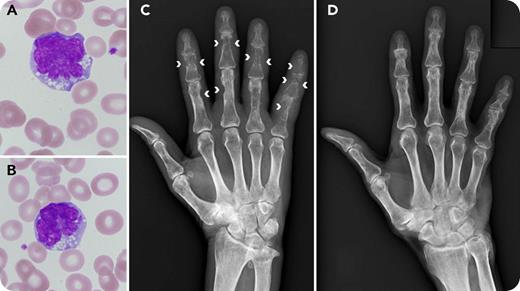 A 68-year-old man with a history of adult T-cell leukemia/lymphoma (ATLL) presented to our outpatient clinic complaining of painful hand swelling of 3 weeks’ duration. Neither enlarged lymph nodes nor skin lesions were observed. The total leukocyte count was normal (5.2 × 109/L) with 3% atypical lymphocytes. The atypical lymphocytes were medium-sized cells with nuclear abnormalities, such as lobulation and notching (panels A-B; original magnification ×1000, Wright-Giemsa stain), and were positive for CD3, CD4, and CD25. The soluble IL-2 receptor level was 17 400 U/mL (normal range, 145-519 U/mL). Radiographs showed multiple subperiosteal bone resorption in the phalanges (panel C; arrowheads). / Subperiosteal bone resorption of the phalanges typically occurs in hyperparathyroidism. Osteoclastic resorption on the periosteal surface gradually proceeds toward the bone center. In our case, serum calcium and intact parathyroid hormone were normal, whereas serum parathyroid hormone–related protein was elevated (1.7 pmol/L; normal range, <1.1 pmol/L). The patient was diagnosed as having relapsed ATLL and received chemotherapy containing the anti-CCR4 antibody mogamulizumab. As a result, rapid relief of the symptoms was obtained. Five months later, the bone lesions also improved (panel D), showing the association of the bone lesions with ATLL disease status. This is the first report of mogamulizumab-sensitive and reversible subperiosteal bone resorption of the phalanges in ATLL.