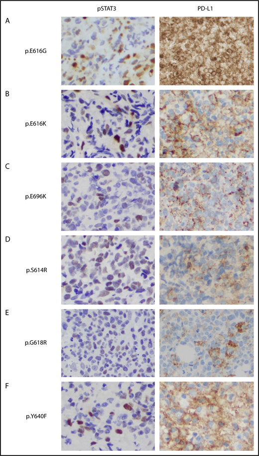 Figure 5. Immunohistochemical staining of phosphorylated STAT3 and PD-L1 in NKTL tumor samples with STAT3 mutations. (A-F) Formalin-fixed, paraffin-embedded sections from tumor biopsy samples of patients with NKTL with novel (p.E616G, p.E616K, p.E696K) and hotspot (p.S614R, p. G618R, p.Y640F) STAT3 mutations that were stained with antibodies against pSTAT3 (left) and membranous PD-L1 (right). Immunohistochemistry shows constitutive phosphorylation and nuclear localization of STAT3 (Y705) associated with high PD-L1 expression in the STAT3 mutant cases (brown staining). Original magnification, ×400.