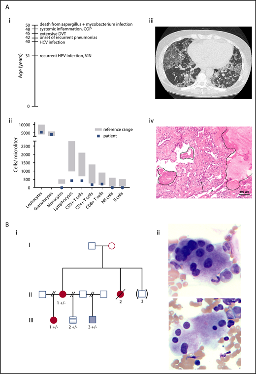 Figure 1. Clinical information on patients. (A) Immunodeficiency patient. (i) Timeline of complications. (ii) Leukocyte and lymphocyte subpopulations at 48 years old. (iii) Computed tomography scan of the lungs at 50 years old showed “crazy paving” as a dominant feature with diffusely distributed ground glass opacities and thickening of the interlobular septa. Additionally, bronchiectasis and reticulations were seen. All findings are compatible with a chronic interstitial lung disease seen in alveolar proteinosis. (iv) Lung biopsy sample with protein rich exudates (line), interstitial broadening with fibroblast proliferations and scattered lymphocytes (spacing line), and hyperplasia of type II pneumocytes (arrowhead). Patient age 50 years old. Hematoxylin and eosin stain, magnification ×10; Olympus BX-51 microscope and Zeiss AxioCamMR3 camera. (B) Inherited AML/MDS family. (i) Inherited AML/MDS pedigree. Circle, female; square, male; filled red circles, history of AML/MDS; pale blue box, history of thrombocytopenia; blue striped box, normal blood counts (no further workup); unfilled boxes, individuals reported to have normal blood counts. II-1 and III-2 had ptosis. “( )”, adopted-out of the family; “+”, GATA2 wild-type; “-”, p.Thr117= GATA2. (ii) Dysplastic megakaryocytes characterized as mononuclear and with separated nuclear lobes. Pre-PBSCT marrow aspirate from II-1. Wright-Giemsa stain, magnification ×40; Leica DM 2500 microscope and MC170 HD camera. COP, cryptic organizing pneumonia; DVT, deep vein thrombosis; HCV, hepatitis C virus; HPV, human papillomavirus; VIN, vaginal intraepithelial neoplasia.