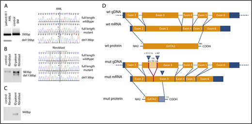 Figure 2. The synonymous mutation c.351C>G (p.Thr117=) in GATA2 leads to GATA2 haploinsufficiency. (A) Agarose gel electrophoresis of RT-PCR product spanning exons 3 to 4 from an AML sample from patient III-1 and a control bone marrow (BM) sample and chromatograms of PCR products. Asterisk indicates mutation/aberrant splice site. (B) Agarose gel electrophoresis of RT-PCR product spanning GATA2 exons 2 to 5 from cultured skin fibroblasts from the immunodeficiency patient (ID) and control cultured skin fibroblasts, as well as chromatograms of PCR products. (C) Agarose gel electrophoresis of RT-PCR product specific for aberrant splice product from cultured skin fibroblasts from the ID patient and control cultured skin fibroblasts. (D) Schematic overview of aberrant splicing product and putative truncated GATA2 protein generated by GATA2 c.351C>G. Blue arrow labeled with “ca” indicates cryptic splice acceptor activated by the mutation; blue arrow labeled with “cd” indicates cryptic splice donor; blue arrow labeled with “T” indicates premature stop at cDNA position 571; light orange box indicates deleted 136-bp mRNA; light blue box indicates stretch of 55 altered amino acids.