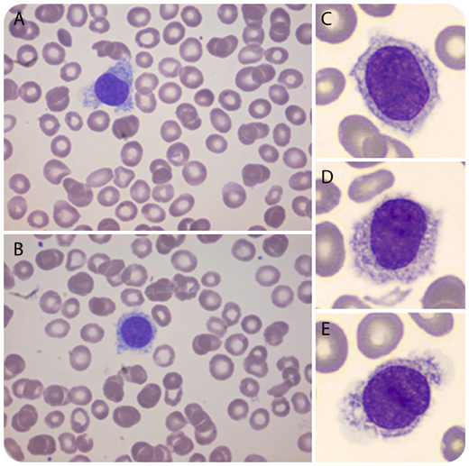 A 16-year-old boy was referred by his general practitioner to a pediatrician because of thrombocytopenia (30 × 109/L) discovered in a routine blood count, which was performed before initiation of treatment with isotretinoin. He had no physical complaints or bleeding tendency. Physical examination revealed no hepatosplenomegaly or lymphadenopathy, and peripheral blood analysis demonstrated a moderate thrombocytopenia, mild neutropenia, mild normocytic anemia, and normal biochemical analysis. Additional microscopic evaluation revealed 17% atypical lymphocytes with hairy projections, suggestive for hairy cell leukemia (HCL) (panels A-E, original magnification ×1000; May-Grünwald Giemsa stain). A bone marrow examination was performed, demonstrating diffuse infiltration of mature B cells immunophenotypically characterized by CD19, CD20, CD22, and FMC7 expression and, to a lesser extent, expression of CD103 and CD11c. Molecular analysis demonstrated a BRAF V600E mutation, strongly supporting the diagnosis of HCL. / HCL is a rare chronic B-cell malignancy accounting for 2% of all leukemias. HCL is predominantly diagnosed in patients >50 years of age and is extremely rare in children, as illustrated by only 3 cases described in the literature. Intriguingly, our patient was diagnosed with HCL following a random hematological evaluation (required to start with isotretinoin therapy) and did not show typical characteristics of HCL, such as hepatosplenomegaly, pancytopenia, and monocytopenia, suggesting a very early diagnosis.