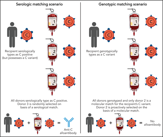 Differences between serologic and genotypic RBC matching. Selection of an RBC donor based on serologic matching may lead to a transfusion recipient with SCD being exposed to a nonself C antigen, for example, potentially resulting in anti-C formation. In contrast, selection of a blood donor based on genotypic matching would mitigate this risk. Professional illustration by Patrick Lane, ScEYEnce Studios.