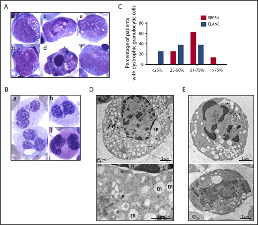 Figure 2. Cytological and ultrastructural characteristics of bone marrow granulocytic cells. (A-B) Cytology analysis after May-Grünwald Giemsa staining. Pictures represent granulocytic precursors (a-f) and neutrophils (g-i)) in different individuals P3, P10, P19, P20, and P23. (Original magnification ×100). (C) Comparative cytological bone marrow analysis of 16 individuals with SRP54 mutations and 16 patients with ELANE mutations Significant difference was observed between SRP54 and ELANE patients using nonparametric Kruskal-Wallis test (P = .02). (D-E) Analysis by TEM of the ultrastructural aspect of bone marrow cells from the granulocytic lineage in patient P1. Enlarged ER was observed around the nucleus (N) and thorough the cytoplasm (Cyt) in promyelocytes (D). The black arrow points to nascent autophagosome. Right panels (E) show pre-apoptotic neutrophil granulocytes, a major characteristic of the sample.