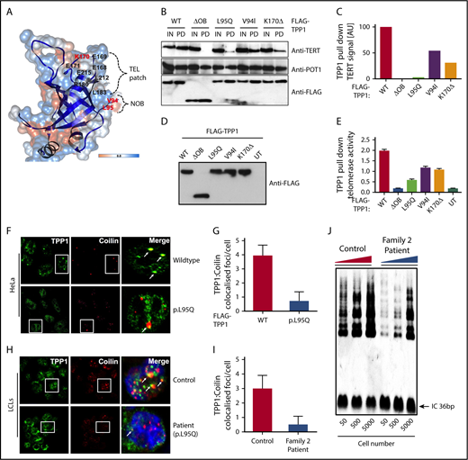 Figure 2. Characterization of TPP1 OB-fold variants extend TEL patch functional domain. (A) In silico model of the TPP1 OB-fold crystal structure (Protein Data Bank accession number 2I46)16 using UCSF CHIMERA, an extensible molecular modeling software. Previously described TPP1-TEL patch residues are denoted in black,12 and the patient variants in BMF patients identified to date are denoted in red. OB-fold ribbon structure is depicted in blue, and surface hydrophobicity preset is shown with amino acid hydrophobicity in the Kyte-Doolittle scale with colors ranging from dodger blue for the most hydrophilic to white at 0.0 to orange for the most hydrophobic. NOB refers to the N terminus of the OB-fold domain that is recently described in telomerase binding.14 (B-C) Immunoblotting of FLAG pull-down (PD) complexes from nuclear extracts of HEK293 cells that are treated with TPP1 3′ untranslated region shRNA and expressing shRNA-resistant FLAG-TPP1 variants along with TERT and POT1. IN refers to 15% input. Note the reduction in TERT signal pulled by the TPP1 OB-fold variants compared with input and WT. (D-E) HeLa cells expressing FLAG-tagged WT TPP1 were analyzed for TPP1-associated endogenous telomerase activity by immunoprecipitation and subsequent telomerase repeated amplification (TRAP) analysis. Results from TRAP assay were normalized based on the amount of eluted TPP1 protein. (F-G) Double immunofluorescence was used to detect the FLAG-TPP1 proteins (green) and coilin (a Cajal body marker, red) in HeLa cells. Yellow (merged green + red) spots (indicated by arrows) show colocalization of TPP1 with coilin, which was quantified by counting cells from different fields of view (n = 2). (H-I) Endogenous TPP1 colocalization with coilin in control and patient (TPP1 p.L95Q) B lymphoblastoid cells. (J) Relative levels of telomerase activity in patient and age-matched control B lymphoblastoid cells at passage 5 were determined by TRAP assay.