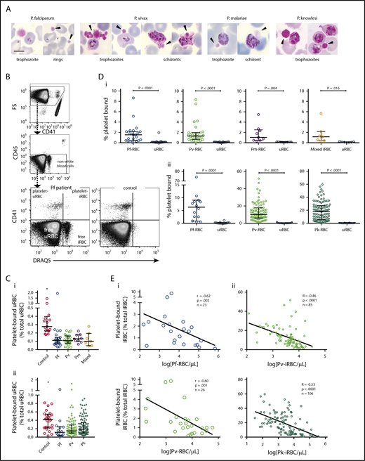 Figure 1. Platelet binding in clinical malaria blood samples. (A) Photos of platelet-bound iRBCs from patient Giemsa smears (black arrowhead = platelet). Images were taken at 1000× magnification using a Samsung Note-3 camera attached to an Olympus CX31 microscope. Scale bar, 5 µm. (B) Representative flow cytometry gating strategy to measure platelet binding in a P falciparum patient and healthy control. (C) Frequency of platelet-bound uRBCs by flow cytometry in patients with malaria compared with control patients in samples from (Ci) Papua (control patients, n = 17; Pf, n = 23; Pv, n = 26; Pm, n = 9; mixed, n = 7) and (Cii) Sabah (control patients, n = 28; Pf, n = 14; Pv, n = 85; Pk, n = 106; Kruskal-Wallis, *significantly different to all other groups). (D) Frequency of platelet-bound iRBCs and uRBCs by flow cytometry in samples from (Di) Papua (n as per Ci) and (Dii) Sabah (n as per Cii; Wilcoxon test). (E) Inverse correlation of platelet-bound iRBCs with parasitemia in samples from (Ei) Papua and (Eii) Sabah (Spearman). Scatterplots indicate median ± interquartile range for each group. Parasitemia values are log transformed. Data presented in supplemental Table 1. Pf, P falciparum; Pv, P vivax; Pm, P malariae; Pk, P knowlesi.
