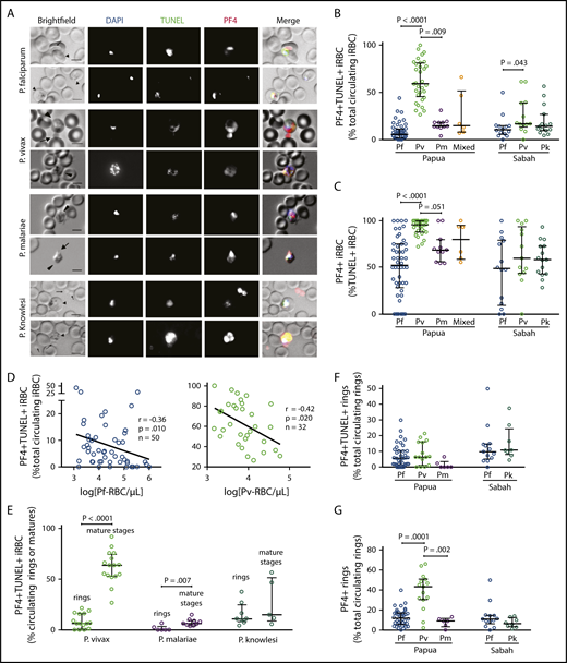 Figure 2. PF4-associated parasite killing in clinical malaria samples. (A) Representative immunofluorescent images from Pf, Pv, Pk, and Pm patient blood smears illustrating PF4-associated parasite killing (PF4+TUNEL+ iRBCs). Scale bars, 5 µm. Arrows and arrowheads indicate platelets and parasites, respectively. Images were taken at 630× magnification on an Axio Scope A1 fluorescent microscope coupled to an Axiocam ICm-1 CCD camera, or an Axio Observer inverted fluorescence microscope coupled to an Axiocam 503 monochrome camera. ZEN 2 software was used for image acquisition and processing (all from Carl Zeiss, Germany). (B) Percentage of PF4+TUNEL+ parasites in clinical samples with Pf (Papua, n = 50; Sabah, n = 14), Pv (Papua, n = 32; Sabah, n = 13), Pm (n = 11), Pk (n = 15), and mixed species infection (n = 6). (C) Comparison of intraerythrocytic PF4 (PF4+) parasites as a percentage of dying (TUNEL+) parasites in Pf, Pv, Pm, Pk, and mixed species infection from Papua and Sabah (n as per B). (D) Inverse correlation of PF4+TUNEL+ iRBCs with parasitemia in Pf and Pv clinical samples (Spearman). (E) Proportions of PF4+TUNEL+ rings vs mature stages in Pv (rings, n = 15; mature, n = 16), Pm (rings, n = 6; mature, n = 9), and Pk (rings, n = 8; mature, n = 5). (F) Proportions of rings that were PF4+TUNEL+ and (G) PF4+ in Pf (Papua, n = 50; Sabah, n = 14), Pv (n = 15), Pm (n = 6), and Pk clinical samples (n = 8). Scatterplots indicate median ± interquartile range for each group. Parasitemia values are log transformed. Kruskal-Wallis or Mann-Whitney test used for statistical comparisons. Data presented in Table 4.