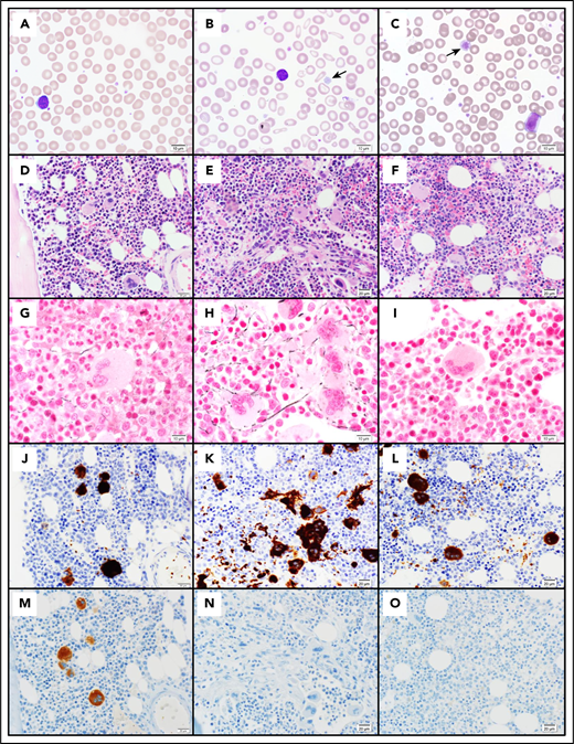 Figure 2. Pathology of cMTFM. Wright-Giemsa–stained peripheral blood smears from (A) a normal control, (B) patient 3-II-4 and (C) the clinically unaffected, genotypically G6b-mutated individual 1-III-9 (original magnification ×1000). Note the large, hypogranular platelets (arrow) and RBC anisocytosis in 3-II-4 and the rare giant platelet in 1-III-9 (arrow). Serial histologic sections of a bone marrow biopsies from (D,G,J,M) a normal control individual, (E,H,K,N) 3-II-4, and (F,I,L,O) 1-III-9 stained with (D-F) H&E (original magnification ×400), (G-I) Reticulin (original magnification ×600), (J-L) the megakaryocytic marker CD61 (original magnification ×400), and (M-O) G6b-B (original magnification ×400). Atypical megakaryocytes present in stellate clusters associated with increased reticulin staining are characteristic of cMTMF. Staining for G6b-B is entirely negative in the megakaryocytes and platelets from 3-II-4 and 1-III-9.