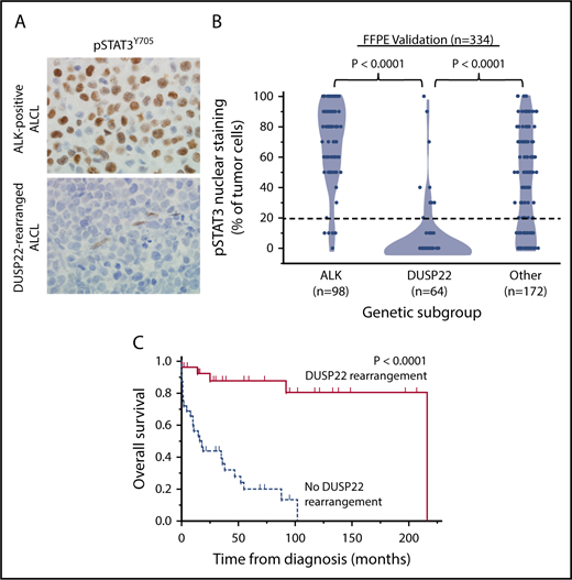 Figure 2. ALCLs with DUSP22 rearrangements lack phosphorylated STAT3 protein. (A) Immunohistochemistry for pSTAT3Y705 in ALK-positive ALCL and DUSP22-rearranged ALCL; note internal positive control staining in endothelial cells in the bottom image. Original magnification, ×400. (B) Results of pSTAT3Y705 staining in 334 FFPE ALCLs independent from the frozen discovery set, stratified by genetic subtype. (C) Prognostic significance of DUSP22 rearrangement in 59 systemic ALK-negative ALCLs that are negative for pSTAT3Y705 by immunohistochemistry (<20% of tumor cells with nuclear staining; log-rank test; see also supplemental Tables 6 and 7).