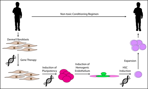 Figure 3. A potential first in human study of in vitro–derived HSCs. Dermal fibroblasts are collected from a patient with a congenital marrow failure syndrome such as Fanconi anemia. Gene therapy corrects the primary genetic defect. Gene-corrected fibroblasts are used to generate iPSCs by expression of OCT4, SOX2, KLF4, and c-MYC. Hemogenic endothelium is generated in culture, and HSCs are induced by transcription factor transduction. It may be necessary to complete HSC induction and expand these cells in vitro prior to infusion into the patient. Appropriate conditioning regimens must be identified to permit efficient engraftment of these cells while causing minimal toxicity to the patient.