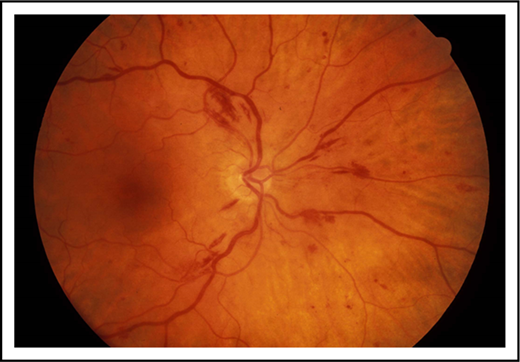 Figure 1. Retinal photograph. Patient with hyperviscosity demonstrating retinal hemorrhages and venous tortuosity.
