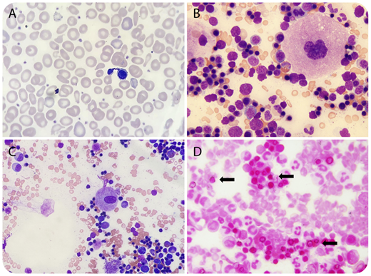 Two unrelated males experiencing microcytic anemia since birth presented for bone marrow examination. Their peripheral blood smears demonstrated anisocytosis and nucleated red blood cells (panel A; original magnification ×1000, Wright-Giemsa stain) with normal platelet counts. Their bone marrow aspirate smears showed abnormal megakaryocytes consisting of both hypolobated (panel B, 10-month-old patient; original magnification ×1000, Wright-Giemsa stain) and monolobated (panel C, 22-month-old patient; original magnification ×400, Wright-Giemsa stain) forms with mature cytoplasm and chromatin. Iron stain demonstrated numerous ring sideroblasts (panel D; original magnification ×1000). Both bone marrow core biopsies were normocellular with morphologically abnormal megakaryocytes present in normal numbers and normal distribution. Cytogenetic studies revealed normal male karyotypes. The patients were found to have congenital sideroblastic anemia, B-cell immunodeficiency, periodic fevers, developmental delay (SIFD), along with biallelic TRNT1 mutations. / TRNT1 encodes a ubiquitously expressed enzyme required for nuclear and mitochondrial transfer RNA function, attesting to its multisystemic roles and the varying clinical phenotypes of SIFD patients. Although platelet counts and functions are not affected to date, an alteration in hematopoiesis beyond erythroid lineage, including megakaryopoiesis, appears to be biologically plausible. Examination of additional cases with longer follow-up will be helpful to further evaluate the prevalence and significance of morphologically abnormal megakaryocytes in SIFD patients.