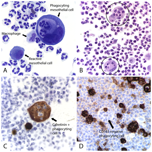 A 96-year-old man was brought to the emergency department for confusion and a 1-week history of nonproductive increasing cough. His temperature was 38.94°C, blood pressure 92/40 mm Hg, heart rate 76 beats/min, respiratory rate 26 breaths/min, and pulmonary examination revealed rales in the bases. Significant laboratory results revealed a white blood cell count of 23 000 × 109/L and glucose 159 mg/dL. The patient was admitted and empiric antibiotics were initiated for suspected septic shock secondary to pneumonia. A chest radiograph and subsequent ultrasound showed a right lower lobe infiltrate and a moderate right pleural effusion. A thoracentesis was performed and the pleural fluid was found to be straw-colored and hazy with a red blood cell count of 1400/mcL and a white blood cell count of 19 000 × 109/L. Microscopic examination of the pleural fluid revealed mostly neutrophils and occasional reactive and large multinucleated mesothelial cells demonstrating active phagocytosis of neutrophils. / Previous studies have reported that after an inflammatory stimulus, mesothelial cells can rarely express macrophage markers and possibly differentiate into phagocytic macrophage-like cells (panel A: original magnification ×100, Papanicolaou stain; panel B: original magnification ×100, hematoxylin and eosin stain; panel C: original magnification ×100, calretinin; panel D: original magnification ×100, CD163). After 10 days, the patient showed clinical improvement and was discharged with oral antibiotic treatment.