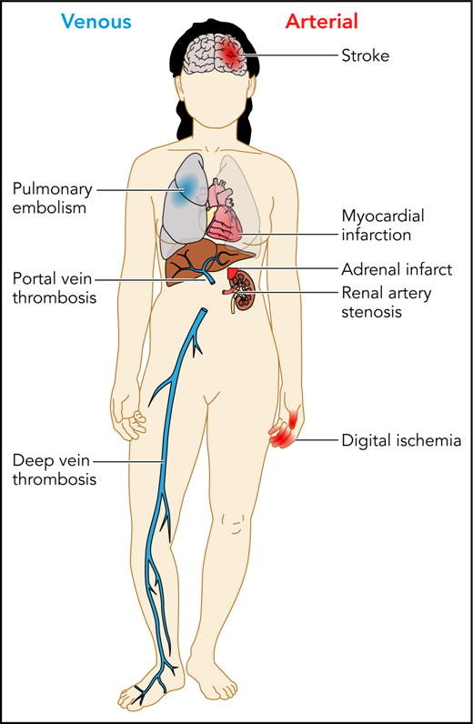 Patients with APS can experience a variety of thrombotic complications, both arterial and venous. Professional illustration by Patrick Lane, ScEYEnce Studios.