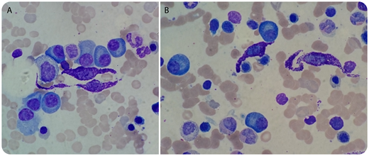 An 83-year-old man presented with hematuria and bone pain. Computed tomography–scan imaging demonstrated multiple osteolytic lesions and vertebral collapse. A complete blood count showed anemia with hemoglobin of 9.1 g/dL and normal white blood count and platelets, 4.95 × 109/L and 198 × 109/L, respectively. Total protein was at 105 g/L, with electrophoresis revealing a monoclonal band, identified as immunoglobulin G ĸ at 50 g/L. Bone marrow smear examination found plasma cells comprising 38% of total nucleated cells (TNCs) and an unexpected infiltration (3%) of abnormal mast cells (MCs) with a spindle-shaped morphology (panels A-B; May-Grünwald Giemsa staining, original magnification ×1000). Serum tryptase was elevated at 161 µg/L, and next-generation sequencing revealed D816Y mutation at the exon 17 of the kit gene, found in the MCs, confirming a diagnosis of systemic mastocytosis with an associated hematological neoplasm (SM-AHN). Flow cytometry analysis showed aberrant expression of CD2 and CD25 on the MCs. / After 3 months of lenalidomide and dexamethasone, bone marrow plasma cells were at 2% of TNCs, but the infiltrate of abnormal MCs remained unchanged, and serum tryptase was still elevated at 182 µg/L. This case of SM-AHN involving D816Y mutation and myeloma demonstrates the benefit of microscopic examination as relatively common diseases can hide even the rarest hematologic malignancies.