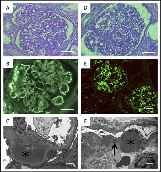 Figure 1. Histopathological features of MGCS-related PGNMID and C3 glomerulonephritis. PGNMID (A-C). (A) Light microscopy with periodic acid–Schiff staining (original magnification ×400; scale bar, 50 μm). Membranoproliferative glomerulonephritis with mesangial and endocapillary hypercellularity. (B) Immunofluorescence study showing monotypic IgG glomerular deposits that stained positive with the anti-gamma3 conjugate. Similar staining was observed with the anti-κ conjugate, whereas staining with conjugates specific for α, μ, gamma1, gamma2, and gamma4 heavy chains and λ light-chain conjugate was negative (not depicted). Scale bar, 50 µm. (C) Electron microscopy confirmed the diagnosis of PGNMID with granular nonorganized electron-dense deposits predominant in the subendothelial space (asterisk), suggestive of immune complex–mediated glomerulonephritis (original magnification ×15 000; scale bar, 1 µm). (D-F) MGCS-associated C3 glomerulonephritis. (D) Light microscopy showing a pattern of proliferative endocapillary glomerulonephritis (periodic acid-Schiff staining; original magnification ×400; scale bar, 50 μm). (E) By immunofluorescence, mesangial and glomerular capillary wall deposits stained positively with the anti-C3 FITC-conjugate (original magnification ×200), whereas no staining was observed with conjugates specific for γ, α, and μ heavy chains and with anti-κ and anti-λ conjugates (not depicted). Scale bar, 50 µm. (F) Electron microscopy demonstrated the presence of voluminous subepithelial electron-dense deposits (humps, asterisk) and interrupted intramembranous dense deposits (arrows) (original magnification ×15 000; scale bar, 1 µm)