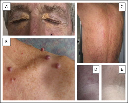 Figure 2. Three different MGCS-associated skin manifestations. (A) Normolipemic xanthoma with marked periorbital involvement in a patient with decreased total complement activity (CH50) and serum C4 level suggesting classical complement pathway activation by immune complexes. (B) Glomeruloid hemangiomata in a patient with POEMS syndrome, likely resulting from the effects of VEGF on angiogenesis. (C-E) Skin lesions of Schnitzler syndrome. (C) Typical pseudourticarial aspect predominantly involving the back. (D-E) Close-up view of lesions of the upper limb in another patient illustrating the efficacy of anakinra and showing initial lesions (D) and normal aspects (E) of the skin obtained after the first injection of the IL-1 antagonist. Skin lesions did not recur after 2 years of follow-up from diagnosis on continuously maintained daily treatment.