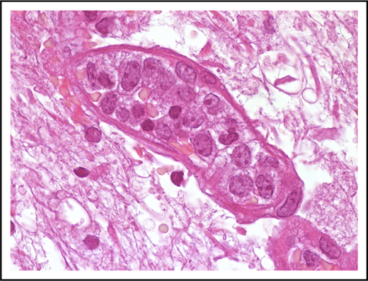 Figure 1. Morphological features of IVLBCL. A blood vessel lumen filled mainly with large B neoplastic lymphocytes, mostly resembling centroblasts. Hematoxylin-and-eosin stain; original magnification ×1000.