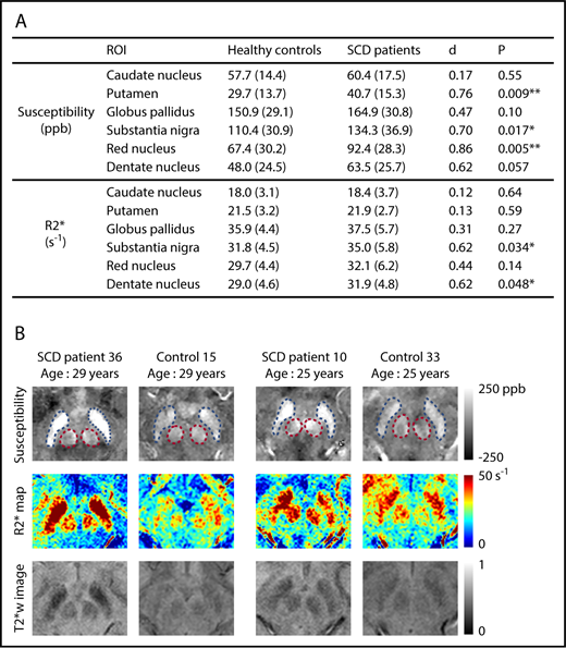 Figure 1. SCD patients exhibit higher susceptibility and R2* in multiple subcortical nuclei, compared with age-matched controls. (A) Average susceptibility (ppb) and R2* (per second) of deep gray matter ROIs in SCD patients and healthy controls. Values are reported as mean (standard deviation). All values were corrected for age and sex; d is Cohen’s effect size, which is defined as the difference between group means divided by the pooled standard deviation. **P < .01; *P < .05. (B) Examples of susceptibility and R2* maps in the regions of substantia nigra and red nucleus. Susceptibility maps (top), R2* maps (middle), and T2*-weighted images at an echo time of 20 ms (bottom) are shown. Blue and pink dashed boxes highlight the regions of substantia nigra and red nucleus, respectively. The left 2 columns compare an SCD patient with a control, both of whom are 29 years old, and the right 2 columns compare 2 subjects who are both 25 years old.