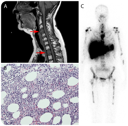 A 47-year-old woman presented with complaints of severe, persistent neck pain, 7 years after treatment of severe aplastic anemia with immunosuppression (antithymocyte globulin, methylprednisolone, and cyclosporine). A complete remission was achieved 5 months after this treatment. When her complaints were analyzed with a magnetic resonance imaging (MRI) scan of the cervical spine, an image suspicious for metastases in several vertebral corpora was found (panel A, MRI of the cervical spine; arrows indicate aberrant signals of the corpus of cervical vertebra 4 and thoracic vertebra 2). An 18F-fluorodeoxyglucose positron emission tomography (18F-FDG-PET) computed tomography (CT) scan revealed FDG-avid lesions throughout the axial spine, sternum, sacrum, femurs, and both mammae. Biopsies were taken from the mammary lesions, showing no malignancy. Subsequently, biopsies were taken from the right femur and sacrum, showing normal hematopoiesis without suspicion for malignancy (panel B; original magnification ×20, hematoxylin and eosin stain). Next, bone-marrow (BM) scintigraphy (99mTc-nanocolloid) was performed, confirming focal spots of increased BM activity in the suspected lesions (panel C). Here, increased and patchy BM activity may have been caused by patchy BM reconstitution in response to treatment in the setting of aplastic anemia. On MRI or 18F-FDG-PET/CT scan, increased BM activity may mimic malignant disease. BM scintigraphy using 99mTc-nanocolloid is preferred over 18F-FDG-PET or 18F-fluorothymidine–PET scan to demonstrate this, because it differentiates between hematopoiesis and other tissues. / Clinically, the neck pain resolved spontaneously and was probably unrelated to BM activity because the patient had no pain at other involved sites.