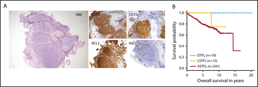 Figure 1. Histopathology and clinical outcome of DTFL. (A) Histopathological features of DTFL. Hematoxylin and eosin staining (H&E) of a representative case (#K17), and immunohistochemical staining for BCL2, CD20, CD10, and Ki67. (B) Kaplan-Meier curves for overall survival of DTFL, LSTFL, and ASTFL cohorts.