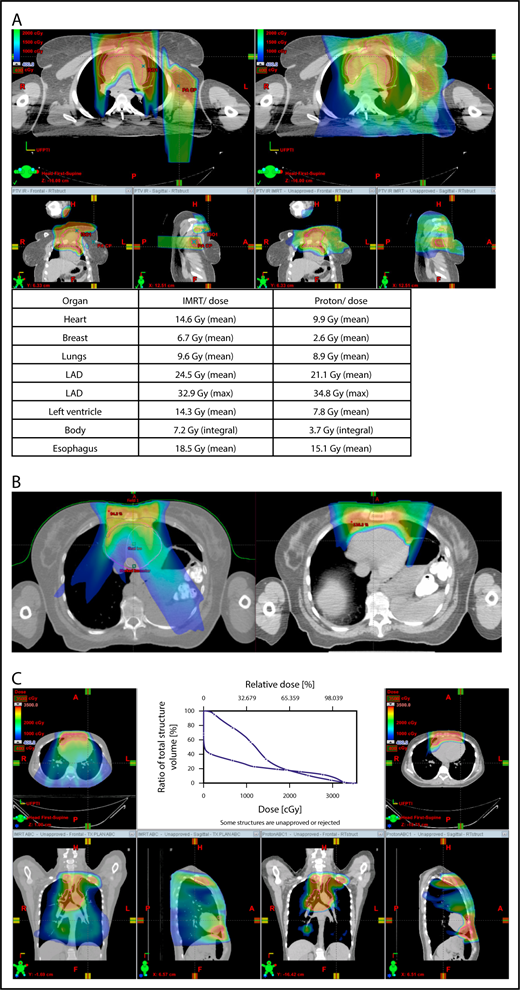 Figure 3. Axillary involvement at presentation. (A) Axial, coronal, and sagittal views of a proton plan (left) and an IMRT plan (right) for a patient presenting with axillary involvement. Use of proton therapy in this case spares the left breast. (B) Regardless of which treatment modality is chosen, IMRT (left panel) and proton (right panel), limiting the volume exposed to radiation should include attention to avoiding a low-dose bath. (C) Limiting lung dose. If avoiding the lung is the primary objective in a given patient, especially if the patient has received pulmonary toxic chemotherapy (eg, any combination of bleomycin, busulfan, gemcitabine, brentuximab, etc.), proton therapy may better spare the lungs by reducing the low-dose bath seen with photons.