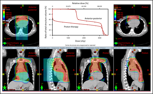 Figure 4. An example of an approach using 2 anterior fields with proton therapy, which can better spare the heart and esophagus (right) compared with an anterior/posterior approach (left).