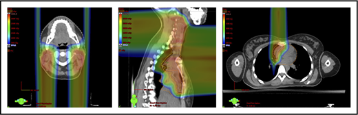 Figure 5. Plans for PBSPT with a single-field uniform dose and a gradient match, with anterior and posterior beams used to treat disease that involves the bilateral upper neck and the mediastinum (disease anterior to the right heart).