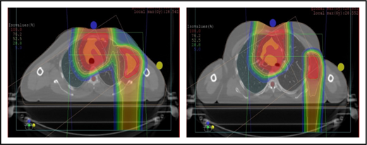 Figure 6. Scans for a young woman in whom the target included mediastinal, left parasternal, and left axillary regions. One anterior field was used for the mediastinum, and a separate posterior field was used for the axillary region.