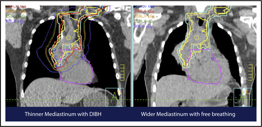 Figure 7. Use of DIBH can help to manage some of the uncertainties associated with the use of proton therapy. Compared with free breathing (right panel), DIBH expands the lungs, moves the heart downward, and causes the mediastinum to become thinner (left panel).