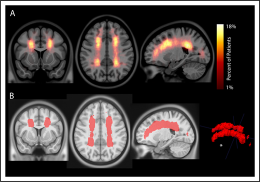 Figure 2. Infarct density map from 286 children with SCA and SCIs in the SIT Trial. Infarct density was calculated for each voxel as the sum of participants with a lesion in that voxel divided by the total number of participants evaluated in the cohort. (A) Infarct densities range from 1% to 18%, with greatest densities falling in the deep white matter of the frontal and parietal lobes. (B) The infarct density map was thresholded to determine the region which encompassed SCIs from 90% of the cohort. The volume of this region was 5.6% of total intracranial volume. *SCIs for 90% of children are located within a confined region (5.6% of total brain volume).