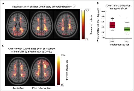 Figure 5. Infarct density maps in children with overt infarct and in children with SCIs who had overt infarct or recurrent silent infarcts by 3-year follow-up. (A) Infarct density map for children in the SIT Trial with SCIs, but excluded from adjudication as an SCI as a result of having an overt infarct (n = 13). Overt infarcts are predominantly located within the border zone region, however, were larger and extend into the gray matter. (B) Mean cerebral blood flow was measured within regions of low (1%-25%) and high (26%-50%) infarct density. *White matter cerebral blood flow was lower in the region of highest infarct density (Wilcoxon rank sum test, P < .001). Similar to finding low cerebral blood flow in region of high silent infarct density, these data are suggestive that a nadir in resting cerebral blood flow may contribute to the presence of overt infarcts. (C) Infarct density map for the subset of children in the SIT Trial with SCIs who had overt or recurrent silent infarcts by 3-year follow-up (n = 20). Baseline MRI is shown on left, and 3-year follow-up MRI is shown on right. The baseline MRI scan demonstrated significantly larger lesions than baseline lesions from the larger SIT Trial cohort. The influence of baseline infarct volume on infarct recurrence was evaluated using logistic regression models (Table 3). By 3-year follow-up, the infarct pattern demonstrated persistent regional vulnerability within the border zone territory, yet lesions were enlarged and extended into gray matter.