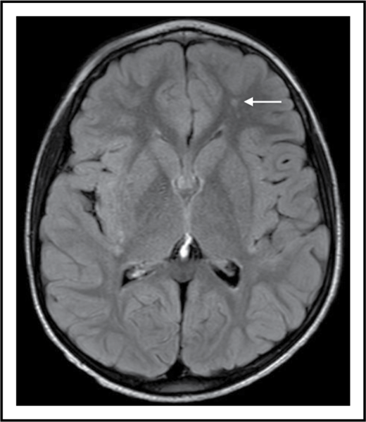 SCI is a supply-side problem in sickle cell anemia. The arrow shows a small stroke by magnetic resonance imaging (MRI) that has no corresponding deficit on physical examination (ie, SCI) in the left frontal white matter in a 6-year-old child with sickle cell anemia.