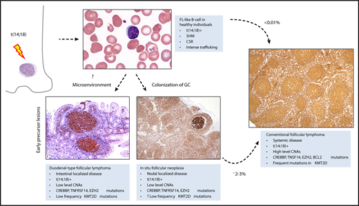 The t(14;18) occurs in a precursor B cell in the bone marrow. B cells carrying the t(14; 18) can be detected at very low levels in the peripheral blood of >50% of healthy adults. These cells have undergone somatic hypermutation (SHM), and class switch recombination (CSR), indicative of transit through the germinal center. They are prone to intense trafficking, with multiple episodes of germinal center reentry. However, <0.01% of patients with FL-like B cells in the peripheral blood subsequently develop FL. Expansion of FL-like B cells, in either the intestine or the lymph node, lead to 2 early lesions, duodenal-type FL, and ISFN. ISFN can be identified in ∼2% to 3% of unselected lymph node biopsies. Both duodenal-type FL and ISFN progress to systemic FL in only 2% to 3% of cases. These early lesions have a low level of copy number aberrations (CNAs), but share many genetic features with conventional FL, including the t(14;18), and mutations in CREBBP, TNFRSF14, and EZH2. However, multiple mutations in KMT2D may be a later event, associated with more advanced disease. Microenvironmental influences may drive colonization of the intestine, independent of the genetic profile. All tissue sections illustrated are stained for BCL2 by immunohistochemistry, original magnification ×40. Peripheral smear, Wright-Giemsa stain, original magnification ×1000. GC, germinal center.