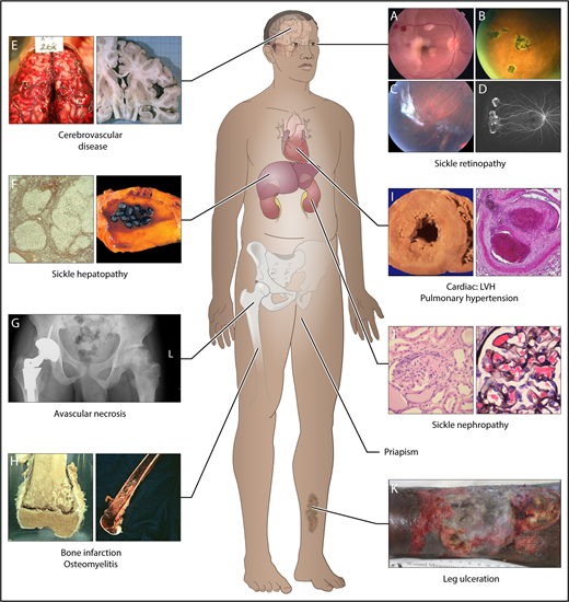 Figure 1. Complications commonly encountered in the older adult with SCD. One study showed that by the fifth decade, almost 50% of surviving SCD patients had documented damage in the organs above.11 In this study, of the 8 organ systems, sickle chronic lung disease was most common, followed by renal failure, retinopathy, osteonecrosis, priapism, gallbladder disease, leg ulcers, and cerebrovascular disease. Frequency of these complications increase with age, but it is also clear that some complications (such as bilirubin levels and gallstones, and sickle nephropathy) are influenced by predisposing or protective genetic variants. The 8 organ system and some of the complications are represented here. (A-D) Sickle retinopathy. Fundus photographs of characteristic retinal lesions observed in sickle cell retinopathy. (A) Arteriolar occlusion with retinal infarcts. (B) Black “sunburst.” (C) Autoinfarcted “sea fan.” (D) Neovascularization in peripheral retina. (E) Cerebrovascular system. Cerebral hemorrhage (left) and atrophy of right cerebral hemisphere (right). (F) Sickle hepatopathy. Light microscopy (silver stain) showing cirrhotic nodules in liver (left) and gallbladder with gallstones (right). (G) Pelvis, avascular necrosis of hip joints. Right hip replacement (left) and early avascular necrosis of left hip (right). (H) Long bones. Infarction of femoral-tibia joint (left) and imaging of osteomyelitis in lower femur (right). (I) Cardiovascular disease. Histopathology showing left ventricular hypertrophy (LVH) of the heart (left) and light microscopy (hematoxylin-and-eosin stain) showing fibrous obliteration of pulmonary vessel with recanalization (right). (J) Sickle nephropathy. Light microscopy (hematoxylin-and-eosin stain) demonstrating large glomerulus and with mesangial hypercellularity (left) and large glomerulus showing sickled red blood cells within the capillaries of the glomerulus (right). (K) Leg ulceration. Chronic intractable ulceration of lower leg above ankle joint.