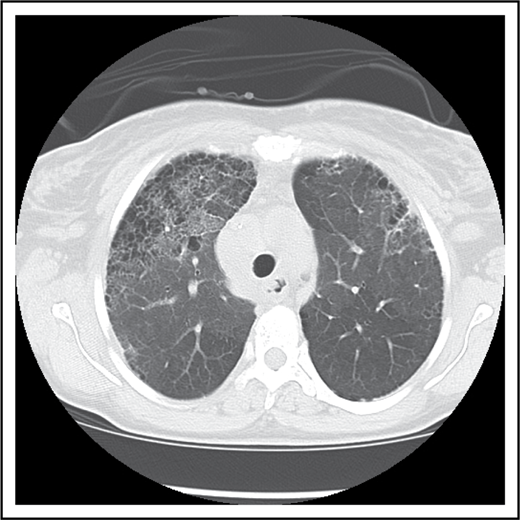 Figure 1. Pulmonary fibrosis complicating multiple episodes of ACS. Axial image of the chest computed tomography of a patient with SCD. Extensive fibrotic changes with honeycombing are noted anteriorly; reticular opacities are appreciated with an anterior predominance, and mild ground glass opacities are noted within the lungs.