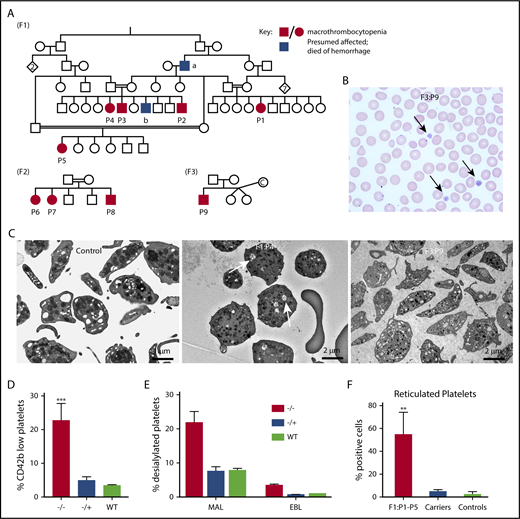 Figure 1. Family and biology studies supporting GNE pathobiology.(A) Family pedigrees. Each family is represented by the designation F1-3. Patients P1 through P9 are shown as black circles (female) and squares (males), whereas unaffected family members are shown as open symbols. Blue boxes refer to potentially affected individuals, but no blood counts were done. Red boxes/circles represent affected individuals. F1 pedigree: The common ancestor “a” died of posttrauma bleeding, whereas “b” died at the age of 2 years from an intracranial hemorrhage. Parents of patients have normal platelet counts and morphology. F2 pedigree, F3 pedigree: “c” refers to an egg donor. (B) A representative hematoxylin and eosin peripheral smear from a patient. Arrows indicate large platelets. (Original magnification, ×60; hematoxylin and eosin stain). (C) Transmission electron microscopy images of platelets isolated from control and indicated patients. Likely dilated open canalicular membrane system that engulfed some debris is shown by the arrows. Bar shown indicates image size. (D) Comparison of percentage of platelets (by FSC/SSC and expression of CD42) that are CD42b low expressing in patients vs heterozygous carriers and unaffected controls. n = 5 patients, 4 heterozygous family members, and 4 unrelated controls. **P = .002 vs control. (E) Fluorescence-activated cell sorter analysis of platelet sialylation levels demonstrating loss of sialylation in platelets from patients with GNE variants. ***P < .001 vs control for MAL. (F) Fluorescence-activated cell sorter analysis of total platelet population on F1 patients (P1 through P5), an obligate F1 carrier (father of P2-P4), and 3 nonaffected controls showing staining for thiazole orange. For panels D and F, graphs show mean ± 1 standard deviation. ***P < .02 comparing affected patients with control patients by Student t test. MAL, maackai amurensis lectin II; SNA/EBL, sambucus nigra lectin; WT, wild type.