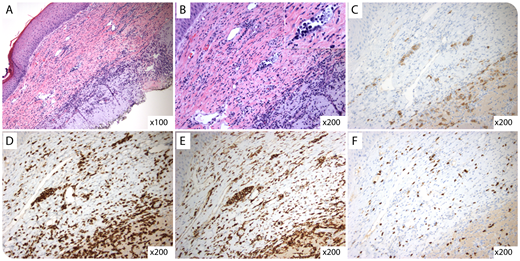 A healthy 80-year-old patient with a history of seborrheic dermatitis presented with an erythematous scalp lesion concerning for basal cell carcinoma. The biopsy showed ruptured folliculitis, dermal scar consistent with a previous biopsy, and focal dermal intralymphatic infiltrates of large mononuclear cells (panels A and B, hematoxylin and eosin stain; original magnification shown on photomicrographs; panel B inset, original magnification ×1000). By immunohistochemistry, the large cells were positive for CD30 (panel C), CD3 (panel D), and CD4 (panel E) and negative for CD8 (panel F), Epstein-Barr virus encoding RNA, CD20, CD56, ALK-1, and TIA-1 (not shown). T-cell receptor (TCR) gene rearrangement studies were negative. The clinical, morphologic, immunophenotypic, and molecular features were consistent with cutaneous intralymphatic CD30+ T-cell pseudolymphoma. / Cutaneous intralymphatic CD30+ T-cell pseudolymphoma is an uncommon, incidental finding with a benign course associated with chronic cutaneous inflammatory conditions or trauma. Histologically, this entity mimics CD30+ intravascular T-cell lymphoma, a rare true lymphoma with poor prognosis, and intralymphatic anaplastic large T-cell lymphoma. Lack of coexpression of TIA-1, granzyme B, CD56, and ALK-1 and a polyclonal pattern TCR gene rearrangement help exclude malignant lymphomas. Diagnosis requires clinicopathologic correlation and localization of CD30+ cells in lymphatic vessels (positive for podoplanin) rather than capillaries or venules.