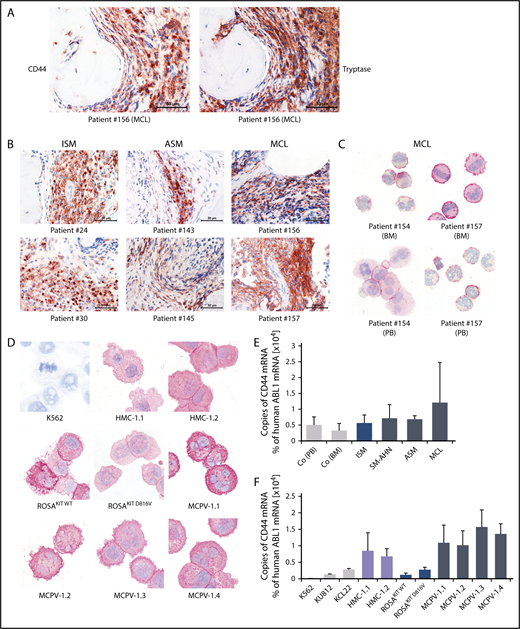 Figure 1. Detection of CD44 in neoplastic MCs by immunostaining and qPCR. (A) BM sections of a patient with MCL (patient 156 in supplemental Table 1) were stained by IHC with an antibody against CD44 (left) and tryptase (right). The spindle-shaped tryptase+ MCs coexpressed CD44. (B) CD44 was also stained in BM sections of patients with ISM (left), ASM (middle), and MCL (right). In all patients examined, CD44 was found to be expressed in the cytoplasm of neoplastic MCs. (C) CD44 expression in primary neoplastic BM MCs (top) and circulating PB MCs (bottom) was analyzed by ICC in 2 patients with MCL. (D) In addition, CD44 expression was determined in the human MC lines HMC-1, ROSA, and MCPV-1. The chronic myeloid leukemia (CML) cell line K562 served as a negative control. MCs stained positive for CD44 in all MCL patients (C) and cell lines (D) tested. Slides were examined using an Olympus DP21 camera connected to an Olympus BX50F4 microscope (Olympus Corporation; Shinjuku, Tokyo, Japan) equipped with 60×/0.90 UPlanFL (IHC) or 100×/1.35 UPlanAPO (Oil Iris; ICC) objective lenses. Images were prepared with 1000× (ICC) or 600× (IHC) magnifications and adjusted by Adobe Photoshop CS5 software version 12.0.4 (Adobe Systems, San Jose, CA). (E) CD44 mRNA expression in mononuclear cells (MNCs) obtained from BM of patients with ISM (n = 3), SM-AHN (n = 4), ASM (n = 2), or MCL (n = 3) or from normal/reactive BM (n = 9) and PB of 6 healthy controls was analyzed by qPCR. (F) CD44 mRNA expression levels were also analyzed by qPCR in various MCL-like cell lines (HMC-1, ROSA, and MCPV-1) and in the CML cell lines K562, KU812, and KCL22. Results are shown as percentage of CD44 mRNA copies relative to ABL1 mRNA levels and are expressed as mean ± standard deviation (SD) of all donors in each group (E) or as mean ± SD of 3 independent experiments (F).