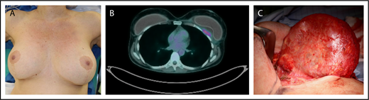 Figure 1. Clinical example of BIA-ALCL. Patient is a 42-year-old woman who presented with a late periprosthetic seroma of the left breast capsule (A) ∼7 years following cosmetic augmentation-mastopexy with bilateral textured breast implants. A fine needle aspirate (FNA) of the periprosthetic effusion demonstrated clonal expansion of CD30+ large anaplastic T cells. (B) A preoperative PET/CT scan demonstrated a posterior capsule wall mass invading the chest wall. (C) Specimen from a bilateral explantation; total capsulectomy with excision of the skin involvement demonstrated a posterior mass on the capsule. Complete surgical excision is essential as residual disease is associated with disease progression.