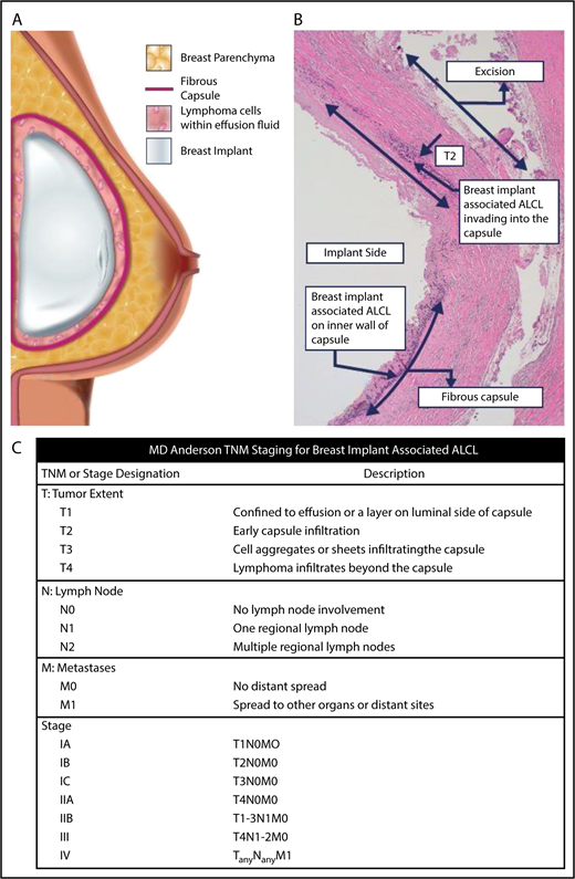 Figure 2. BIA-ALCL schematic and TNM staging. (A) The schematic demonstrates that BIA-ALCL typically presents in the seroma surrounding the breast implant. The lymphoma is usually contained within the fibrous capsule and distinct from breast parenchyma. BIA-ALCL typically is isolated to within the fluid and/or inner wall of the capsule, although invasion into or beyond the capsule is less commonly seen and associated with a worse prognosis. (B) This can be seen histologically or on gross review of the pathology at the time of surgery. (C) Clinical and pathologic staging of BIA-ALCL follows the MD Anderson Solid Tumor Staging System modeled after the American Joint Committee on Cancer TNM stages. Using this system, BIA-ALCL patients have a spectrum of disease from IA (35.6%, effusion only), IB (11.5%), IC (13.8%), IIA (25.3%), IIB (4.6%), III (9.2%), to stage IV (0%). Adapted from Clemens et al7 with permission.