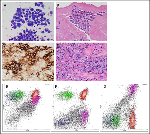 Figure 3. Pathology. (A) Cytological appearances of BIA-ALCL cells on cytopsin preparation from an effusion (original magnification ×600; Giemsa stain). (B) Histological appearances of BIA-ALCL in capsulectomy specimen (original magnification ×400; hematoxylin and eosin stain). (C) CD30 expression by the neoplastic cells of BIA-ALCL (original magnification ×400; immunoperoxidase stain). (D) Foreign body giant cells reaction against silicone particulate shed from textured implant in the capsule. (original magnification ×400; hematoxylin and eosin stain) (E) Flow cytometric immunophenotyping of effusion from a case of BIA-ALCL. The neoplastic cells, shown with purple dots, express CD4 and CD2 (dim) (E) but not CD3 (F). They are brightly positive for CD30. Normal CD4 and CD8-positive T cells are shown in red and green, respectively. Small numbers of NK cells, shown by dark blue dots, are present. The remaining mononuclear cells, shown in gray dots, are mostly macrophages. All panels are gated on mononuclear cells. (G) The flow cytometric gate for CD30.