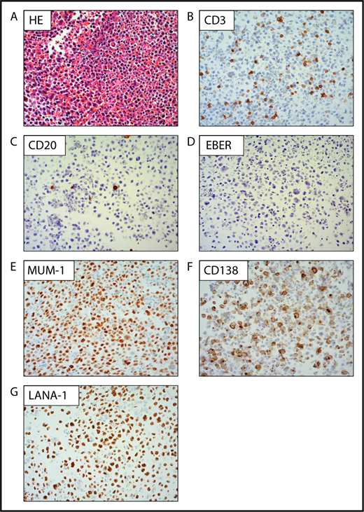 Figure 1. Pathological specimens of PEL. Specimens of a cell block from an HIV− elderly patient with PEL stained by hematoxylin and eosin (HE; A), CD3 (B), CD20 (C), EBV-encoded small RNA (EBER; D), multiple myeloma oncogene 1 (MUM-1; E), CD138 (F), and LANA-1 (G) are shown (original magnification ×200). Staining of CD3 and CD20 on immunohistochemistry (IHC) and EBER in situ hybridization are negative, with positive staining for MUM-1, CD138, and LANA-1 on IHC. All images are courtesy of Koichi Oshima, Kurume University, Kurume, Japan.