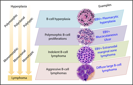 Figure 1. Immunodeficiency-associated B-cell proliferations.