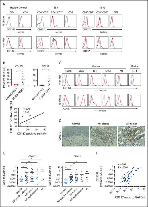 CD137L expression on malignant T cells in CTCL. (A-C) CD137L and CD137 expression was analyzed by flow cytometry in CD4+CD7−, CD4+CD7+, and CD8+ T cells from 10 SS patients, CD4+ and CD8+ T cells from 14 healthy controls (A-B), human CTCL cell lines (Hut78, MyLa, SeAx, HH, and MJ cells), and murine lymphoma cell line EL-4 cells (C). Representative flow cytometric plots are shown (A, C). The percentage of CD137L+ or CD137+ cells was counted in CD4+CD7− T cells from SS patients or CD4+ T cells from healthy controls. Correlations between the percentage of CD137L+ and CD137+ cells in CD4+CD7− T cells were examined (B). (D) CD137L expression in lesional skin of CTCL was determined by immunohistochemistry (original magnification ×400). Diaminobenzidine was used for visualizing the staining and counterstaining with Mayer hematoxylin was performed. Representative results are shown. (E) Quantitative RT-PCR was performed to measure expression levels of CD137L and CD137 using mRNA extracted from CTCL lesional skin (n = 57; 51 MF cases and 6 SS cases) and healthy skin (n = 20). (F) Correlations between CD137L and CD137 mRNA levels in CTCL lesional skin. (G) Kaplan-Meier analysis for disease-specific survival of 57 CTCL patients with high CD137L mRNA levels (>0.0014) and those with low CD137L mRNA levels (≤0.0014). (H) Serum sCD137L and sCD137 levels in CTCL patients (n = 43). (I) Correlations between serum sCD137L levels and sIL-2 receptor (sIL-2R) or lactate dehydrogenase levels (LDH) levels in CTCL patients. Means are presented as bars. *P < .05, **P < .01. GAPDH, glyceraldehyde-3-phosphate dehydrogenase; Max, maximum.