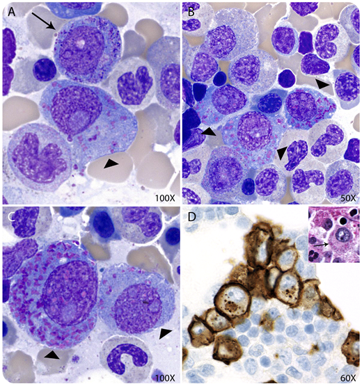 A 70-year-old man with a history of treated immunoglobulin G (IgG)–κ plasma cell myeloma was referred to our institution for continuation of care. A preliminary differential cell count demonstrated 10% promyelocytes and 2% plasma cells. The second review of Wright-stained bone marrow aspirate smears showed 12% atypical plasma cells and 1% promyelocytes (panel A, arrow). Curiously, most plasma cells contained a variable number of coarse cytoplasmic azurophilic crystalline inclusions and resembled promyelocytes (panels A-C, arrowheads). A core biopsy demonstrated ∼15% plasma cells with granular cytoplasm (panel D inset, arrow), negative for periodic acid-Schiff, positive for CD138 by immunohistochemistry (panel D), and κ light chain restricted by in situ hybridization. / Plasma cell cytoplasmic azurophilic crystalline inclusions are rare. They include azurophilic granules of variable size and shapes and Auer rod–like crystals. In the current case, the morphologic features in the plasma cells were prominent enough to confuse them with promyelocytes (panels A-C), but ancillary tests confirmed their plasma cell origin. Azurophilic crystalline inclusions are thought to represent abnormal immunoglobulin deposits secondary to a block in the protein synthetic pathway, whereas Auer rod–like crystals appear to have a lysosomal origin. The recognition of plasma cell cytoplasmic azurophilic inclusions is crucial to avoid erroneous differential cell counts or a misdiagnosis of acute myeloid leukemia.