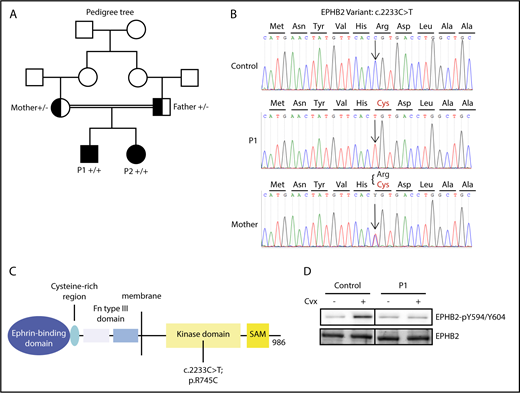 Figure 1. Identification of EPHB2 mutation. (A) The family tree (boxes, males; circles, females). The variant is indicated for P1 and P2 in solid black, while parents heterozygous for the mutation are indicated as half black box and circle (“+” signifies presence of the variant in one allele and “−” the WT in the other allele). (B) Sanger sequences surrounding the mutation (arrow) within the EPHB2 gene for patient P1 (upper sequence, homozygote), the mother (heterozygote), and an unaffected control. (C) Schematic representation of identified domains of the protein EPHB2. Fn, fibronectin; SAM, sterile α motif. (D) Phosphorylation of EPHB2 (EPHB2-pY594/604) in the presence or absence of Cvx (800 pM) was assessed in control and P1 platelets. Vertical lines have been inserted to indicate a repositioned gel lane.