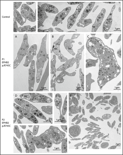 Figure 2. EPHB2 mutation affects platelet morphology. Illustration of the typical platelet ultrastructure for control (top), P1 (A-C), and P2 (D-G) by transmission electron microscopy. (A-B) Elongated platelets P1 with increased maximal diameter and a discoid shape containing few granules; note the abnormal presence of membrane complexes (MC). (A) Asterisk denotes examples of platelets with a sickle shape and extensions of the plasma membrane suggesting a defect of fragmentation. (C) What appears to be a fragment of a megakaryocyte (MK) with the aspect of an unfragmented proplatelet is shown. (D-G) Platelets from P2. (D) Discoid platelets with numerous membrane complexes. (E) An apparent preplatelet with a barbell-shaped appearance. (F) A lower-magnification image shows the heterogeneity in platelet shape; some are discoid and thin while others are round. (G) An unfragmented MK. Scale bars indicate the magnification.